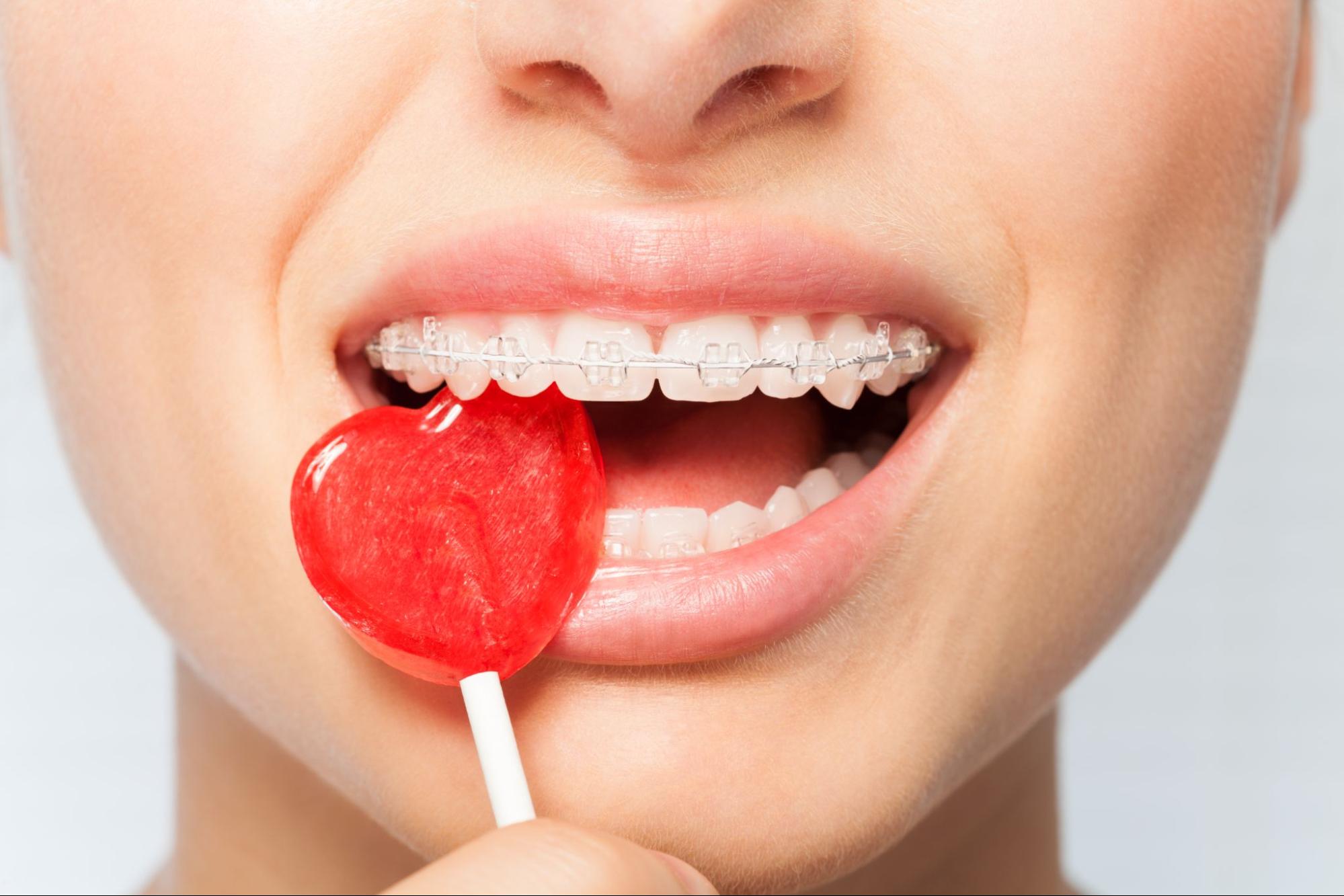 To Eat or Not To Eat: Braces Edition